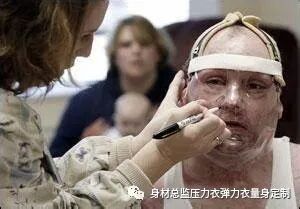 医用夹板怎么软化烧伤患者避免走弯路必读！！！烧伤康复指南--物理治疗、职业治疗、烧伤疤痕挛缩、烧伤压力衣弹力衣定制_https://www.jmylbn.com_新闻资讯_第6张