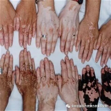 医用夹板怎么软化烧伤患者避免走弯路必读！！！烧伤康复指南--物理治疗、职业治疗、烧伤疤痕挛缩、烧伤压力衣弹力衣定制_https://www.jmylbn.com_新闻资讯_第15张