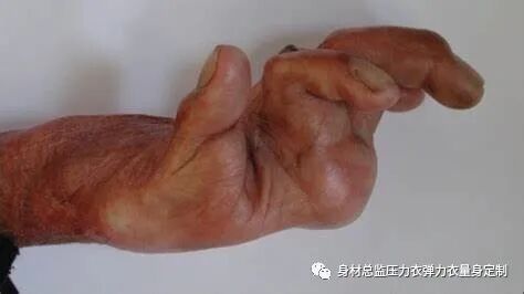 医用夹板怎么软化烧伤患者避免走弯路必读！！！烧伤康复指南--物理治疗、职业治疗、烧伤疤痕挛缩、烧伤压力衣弹力衣定制_https://www.jmylbn.com_新闻资讯_第9张