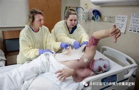 医用夹板怎么软化烧伤患者避免走弯路必读！！！烧伤康复指南--物理治疗、职业治疗、烧伤疤痕挛缩、烧伤压力衣弹力衣定制_https://www.jmylbn.com_新闻资讯_第22张