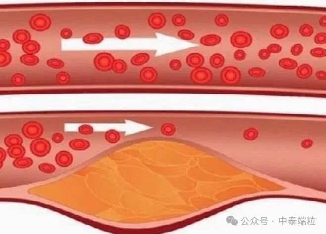 降低胆固醇、甘油三酯水平，包括他汀类药物在内，有9大药物