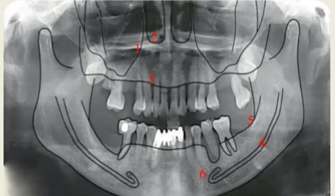曲面断层片怎么看种植术前读片，学会看CBCT、曲断片、根尖片_https://www.jmylbn.com_新闻资讯_第5张