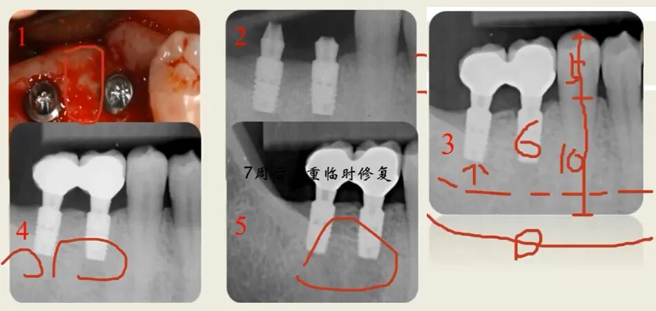 曲面断层片怎么看种植术前读片，学会看CBCT、曲断片、根尖片_https://www.jmylbn.com_新闻资讯_第3张