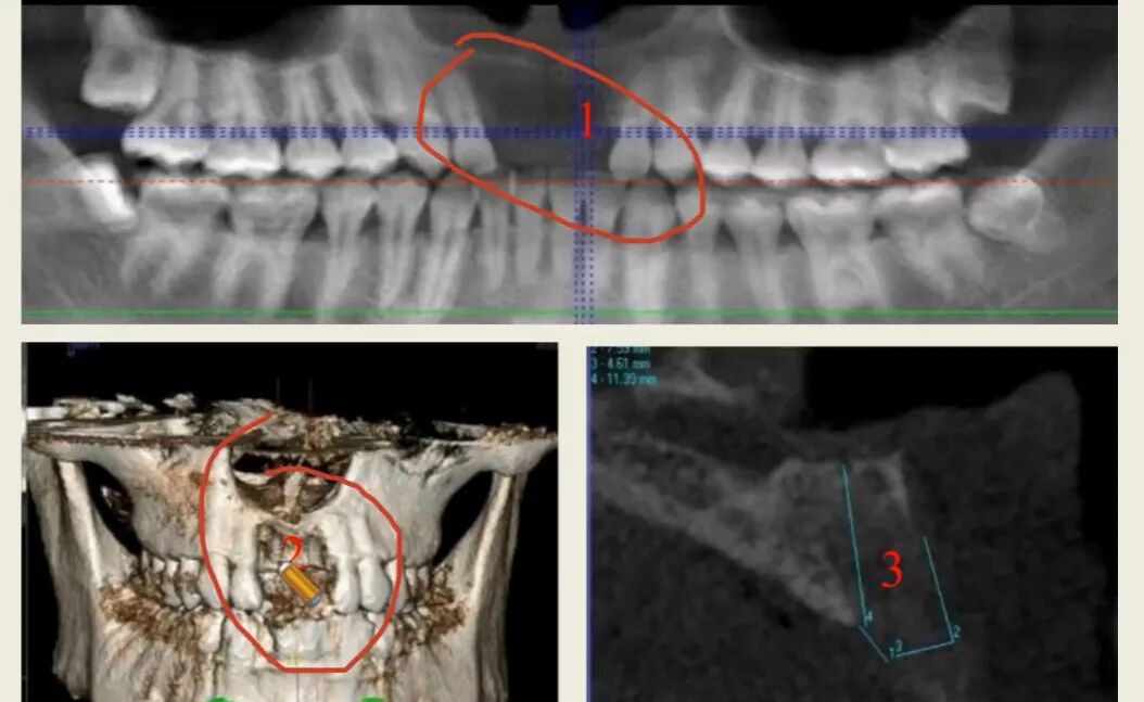 曲面断层片怎么看种植术前读片，学会看CBCT、曲断片、根尖片_https://www.jmylbn.com_新闻资讯_第6张