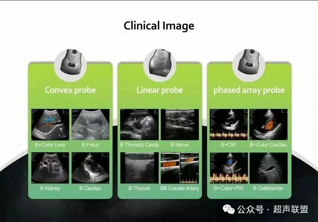 索诺星超声怎么样索诺星和理邦全新彩超机器_https://www.jmylbn.com_新闻资讯_第25张