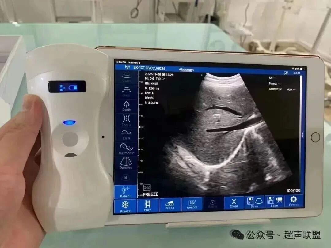 索诺星超声怎么样索诺星和理邦全新彩超机器_https://www.jmylbn.com_新闻资讯_第5张