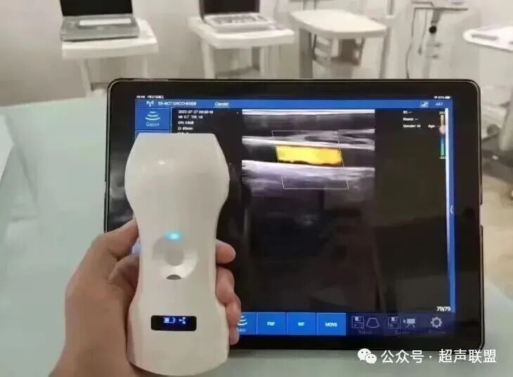 索诺星超声怎么样索诺星和理邦全新彩超机器_https://www.jmylbn.com_新闻资讯_第4张