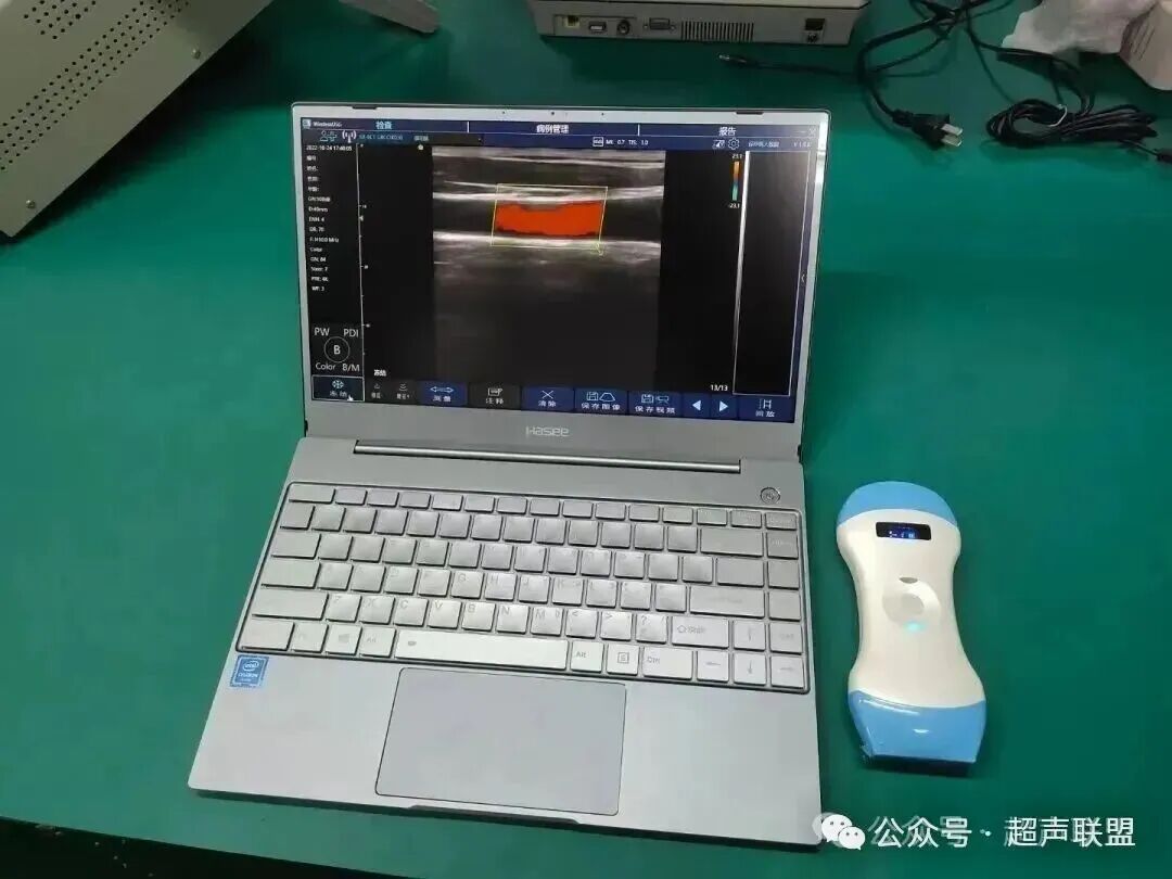 索诺星超声怎么样索诺星和理邦全新彩超机器_https://www.jmylbn.com_新闻资讯_第11张