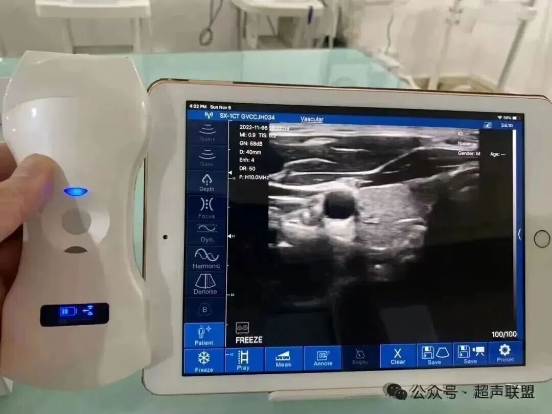 索诺星超声怎么样索诺星和理邦全新彩超机器_https://www.jmylbn.com_新闻资讯_第6张