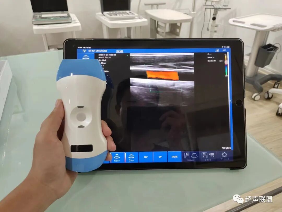 索诺星超声怎么样骶尾部藏毛窦广东（广州）索诺星无线掌超现场试机活动，无线掌超，值得拥有_https://www.jmylbn.com_新闻资讯_第14张