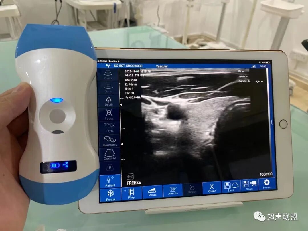 索诺星超声怎么样骶尾部藏毛窦广东（广州）索诺星无线掌超现场试机活动，无线掌超，值得拥有_https://www.jmylbn.com_新闻资讯_第16张