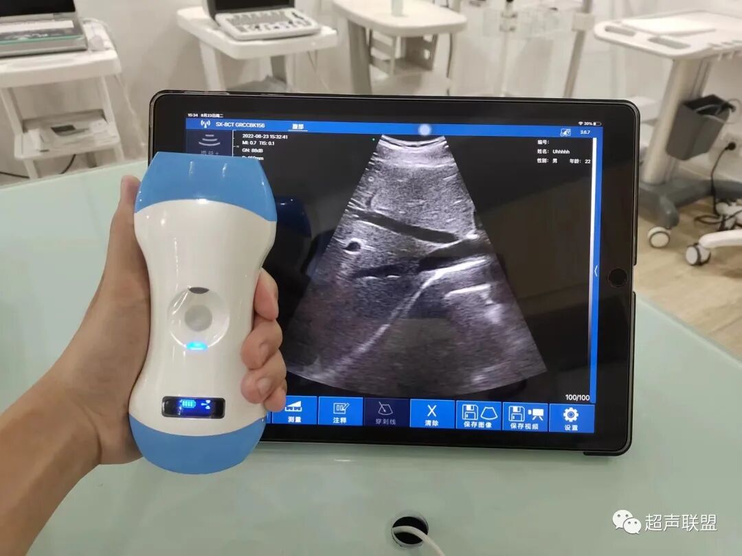 索诺星超声怎么样骶尾部藏毛窦广东（广州）索诺星无线掌超现场试机活动，无线掌超，值得拥有_https://www.jmylbn.com_新闻资讯_第15张