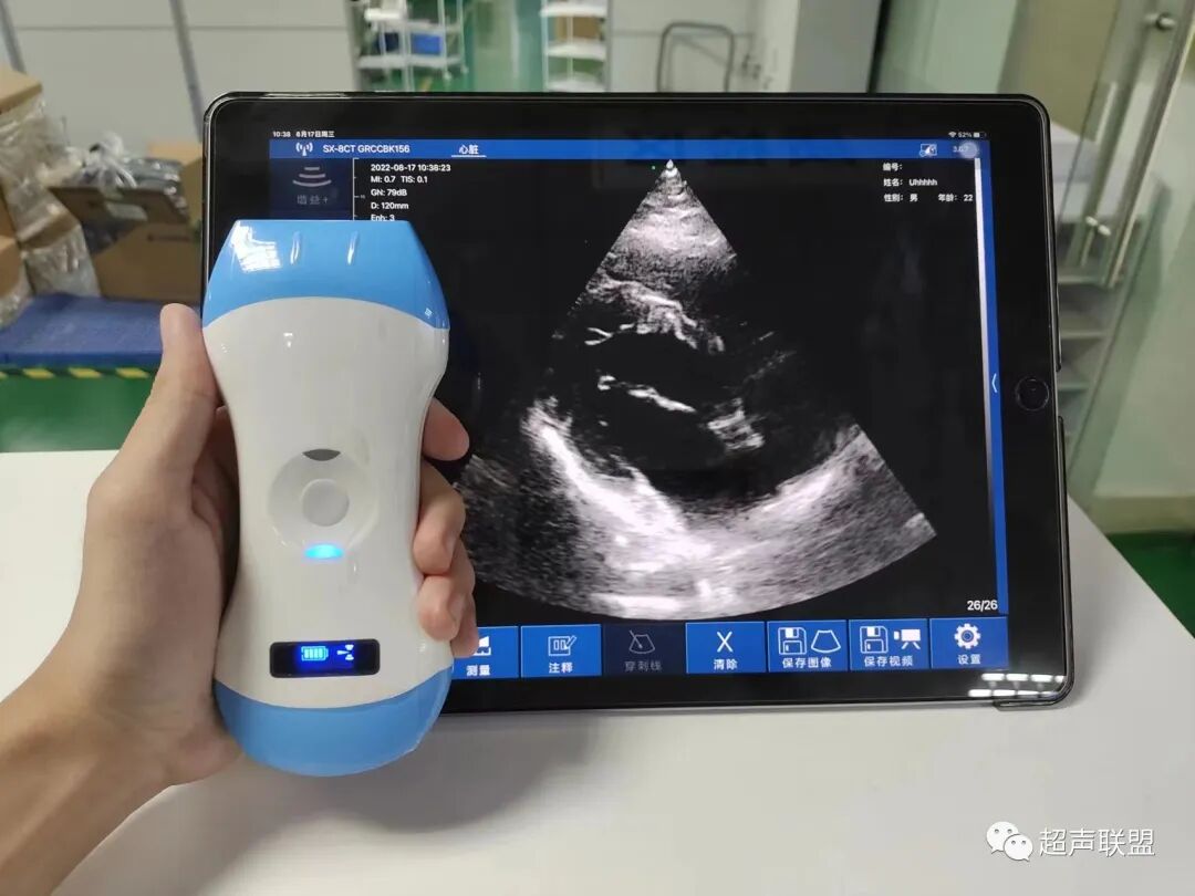 索诺星超声怎么样骶尾部藏毛窦广东（广州）索诺星无线掌超现场试机活动，无线掌超，值得拥有_https://www.jmylbn.com_新闻资讯_第13张