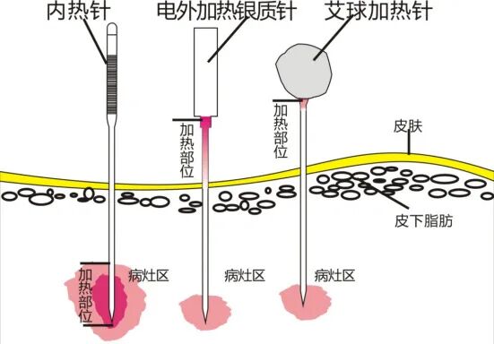 手术刀怎么消毒【特色技法④】内热针疗法：专治慢性顽固疼痛，中医“手术刀”远近期镇痛效力俱佳_https://www.jmylbn.com_新闻资讯_第15张