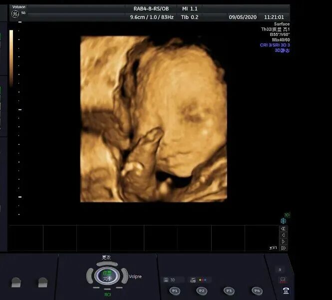 汕头彩超怎么样为什么要做四维彩超，超时了就不能做了？「汕头天佑医院」_https://www.jmylbn.com_新闻资讯_第4张