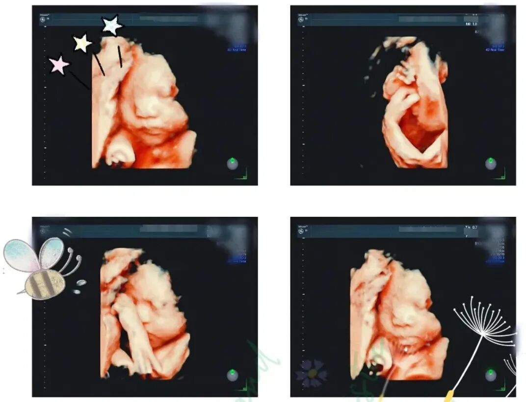 汕头彩超怎么样NT检查、四维大排畸、孕晚期四维小排畸能互相取代吗？「汕头妇产科医院」_https://www.jmylbn.com_新闻资讯_第7张