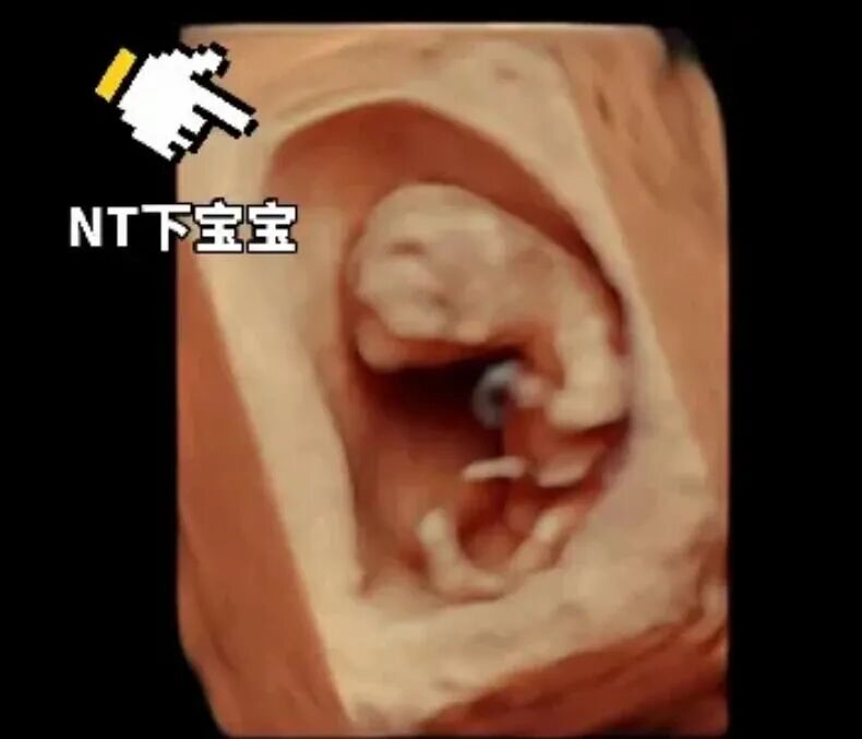 汕头彩超怎么样NT检查、四维大排畸、孕晚期四维小排畸能互相取代吗？「汕头妇产科医院」_https://www.jmylbn.com_新闻资讯_第4张