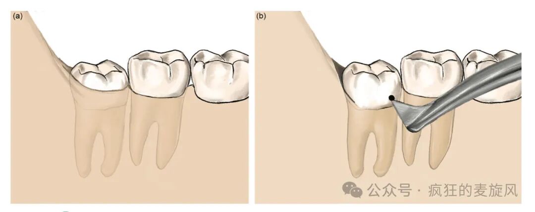 拔除下颌阻生智齿的常见解决方法汇总