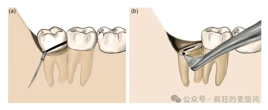 拔除下颌阻生智齿的常见解决方法汇总