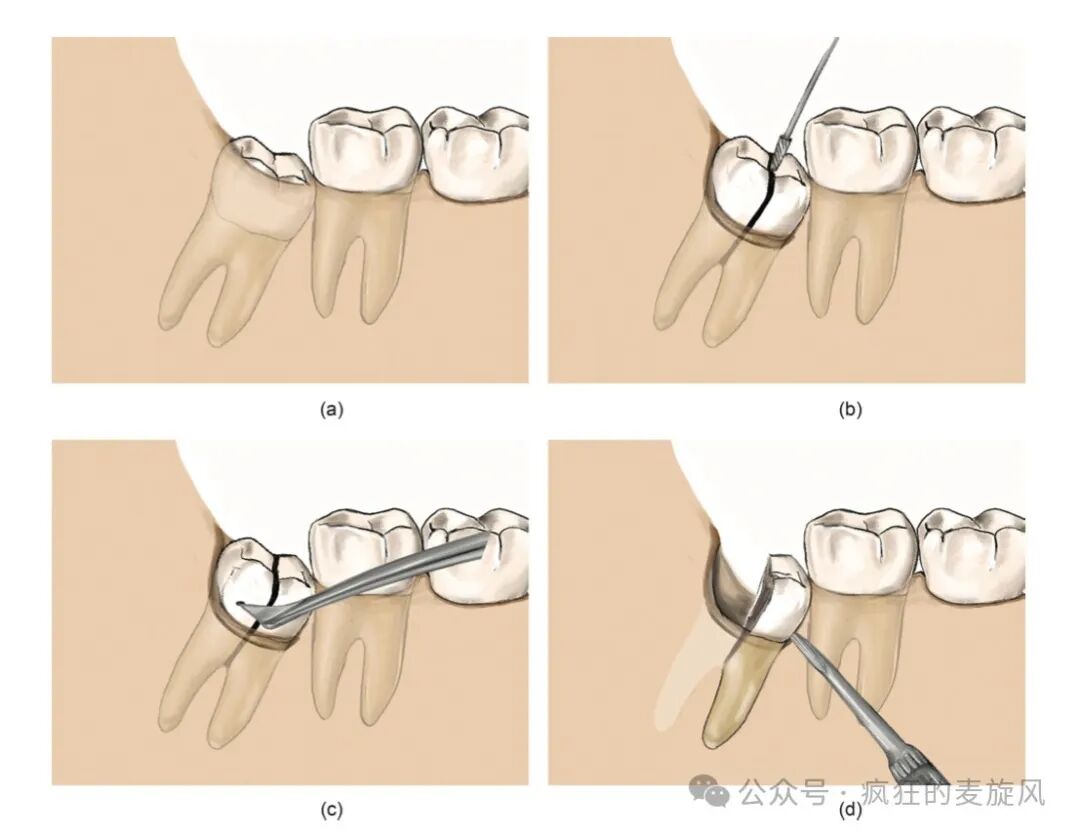 拔除下颌阻生智齿的常见解决方法汇总