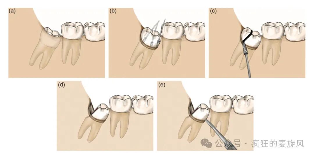 拔除下颌阻生智齿的常见解决方法汇总