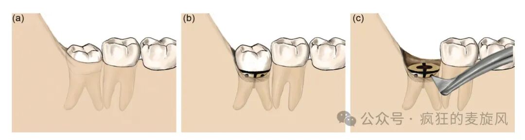 拔除下颌阻生智齿的常见解决方法汇总