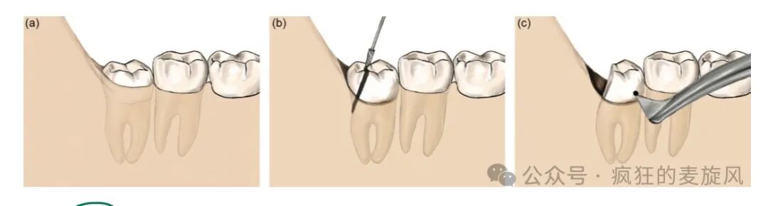 拔除下颌阻生智齿的常见解决方法汇总