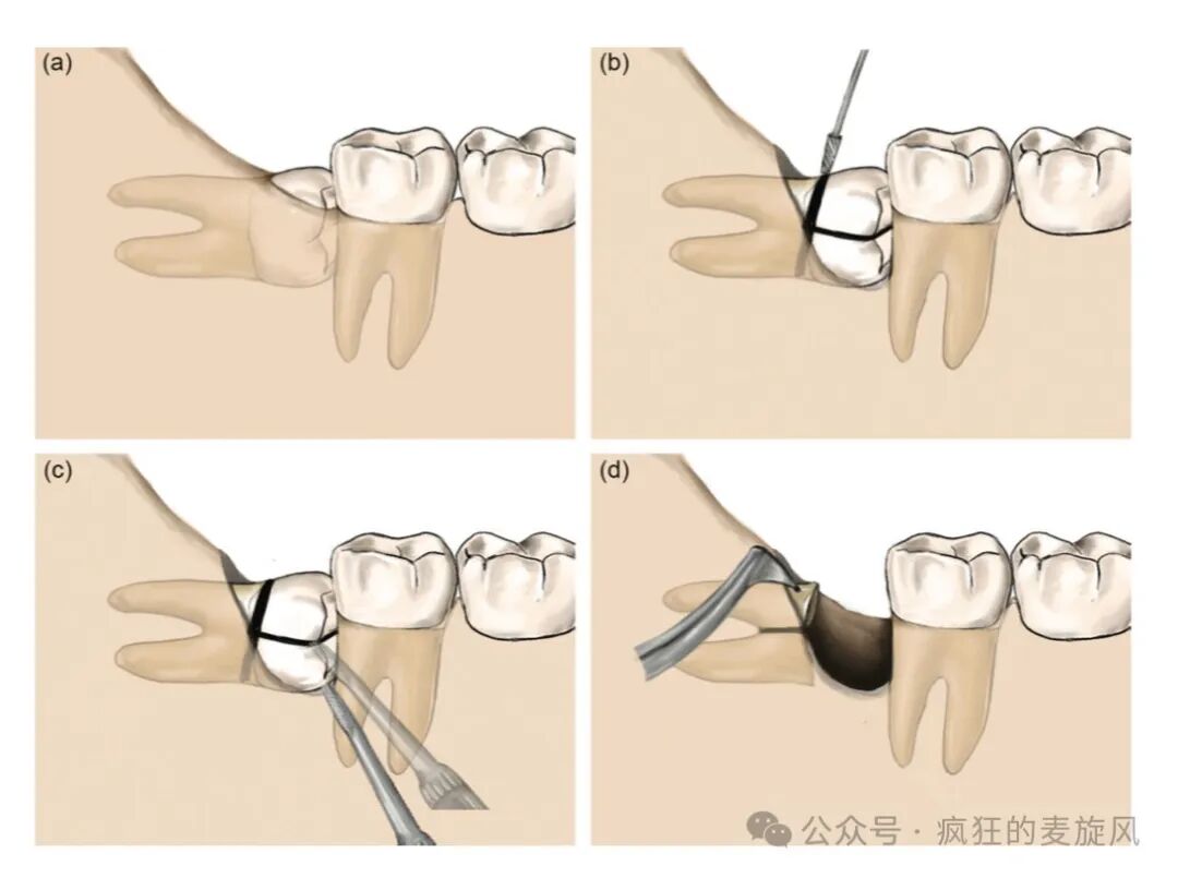 拔除下颌阻生智齿的常见解决方法汇总