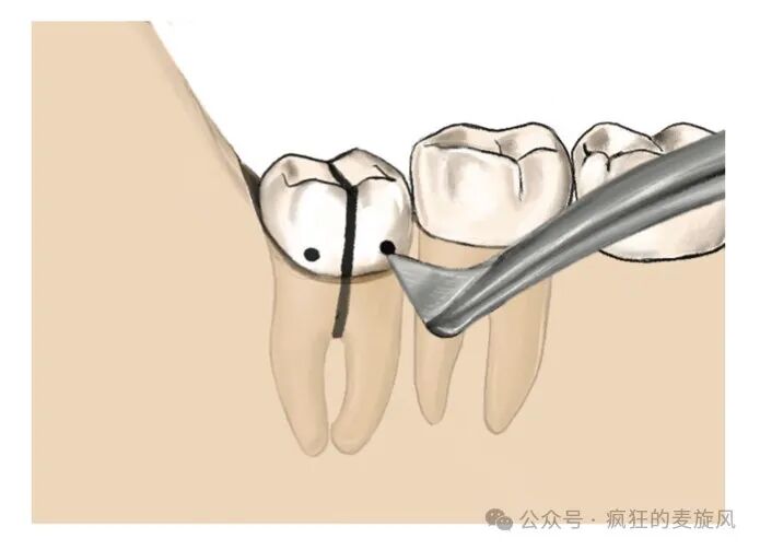 拔除下颌阻生智齿的常见解决方法汇总