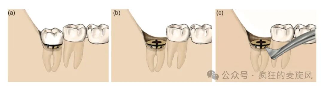 拔除下颌阻生智齿的常见解决方法汇总