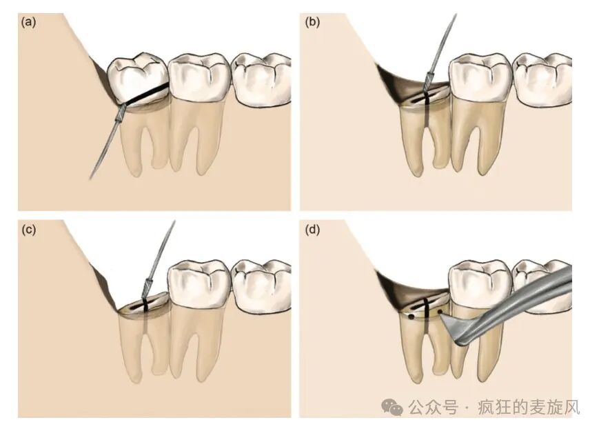 拔除下颌阻生智齿的常见解决方法汇总