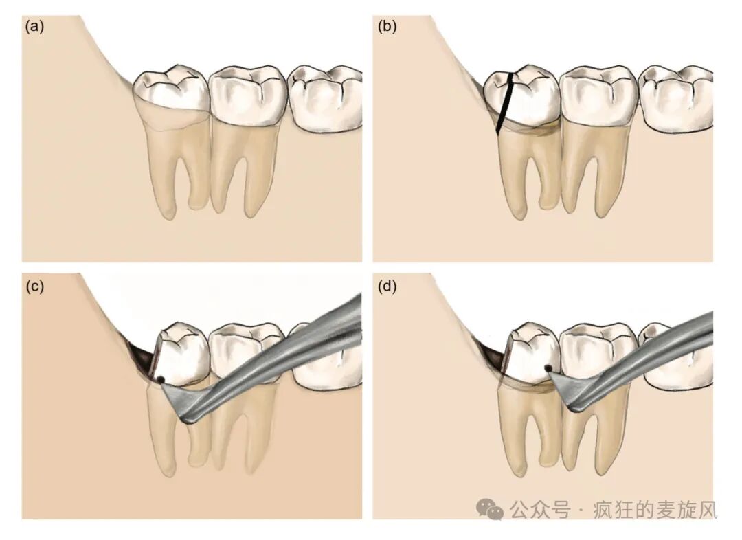拔除下颌阻生智齿的常见解决方法汇总