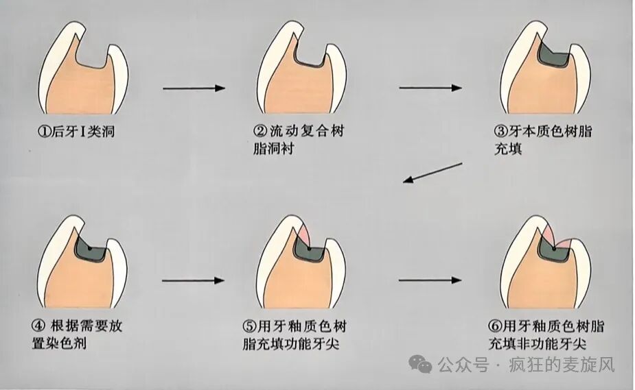 树脂修复活髓牙术后出现敏感可咋整？