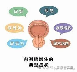 吃药就能好的前列腺增生其实没必要手术，简单五味药，一下尿三丈