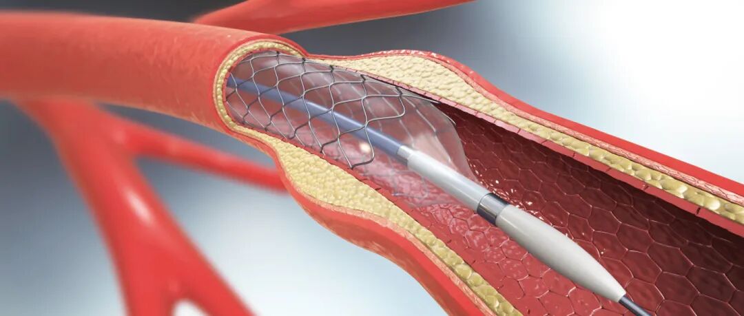 胆道支架都有哪些公司2023年全球十大心脏支架公司！_https://www.jmylbn.com_新闻资讯_第3张