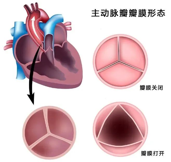 中牟县人民医院成功完成一例“主动脉瓣生物瓣置换术+二尖瓣、三尖瓣成形术”
