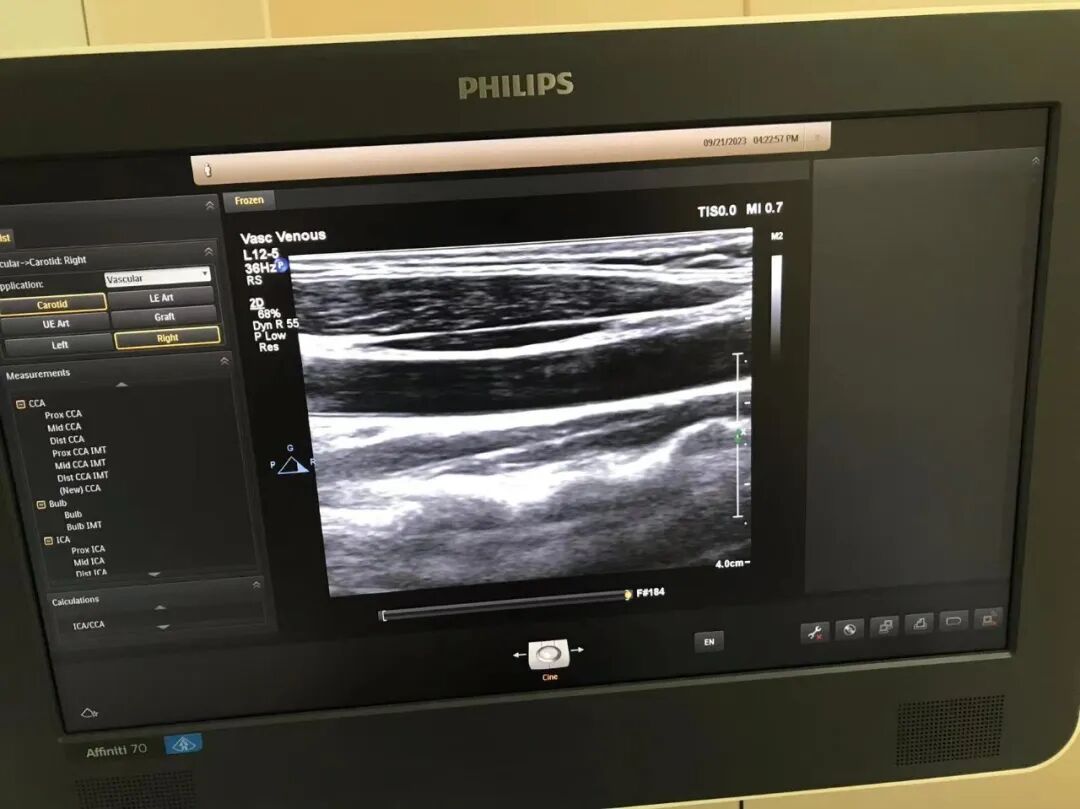 为什么要维修探头飞利浦高频探头L12-5故障维修案例_https://www.jmylbn.com_新闻资讯_第5张