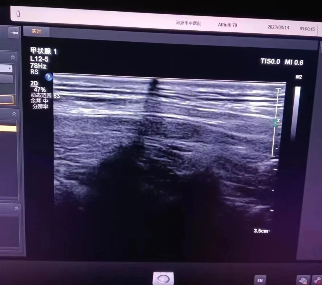 为什么要维修探头飞利浦高频探头L12-5故障维修案例_https://www.jmylbn.com_新闻资讯_第2张