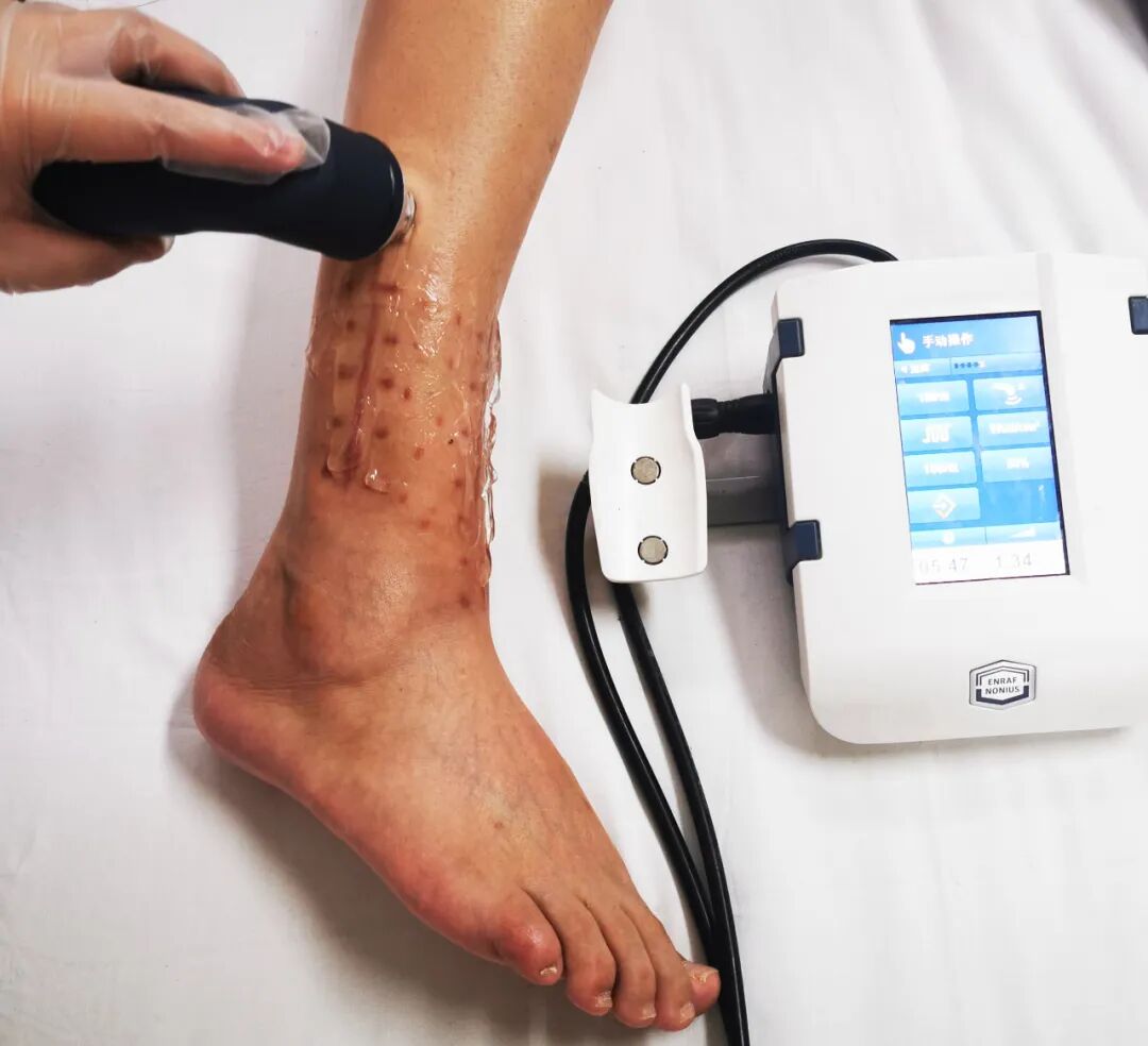 什么是超声波治疗仪【科普】超声波治疗_https://www.jmylbn.com_新闻资讯_第5张