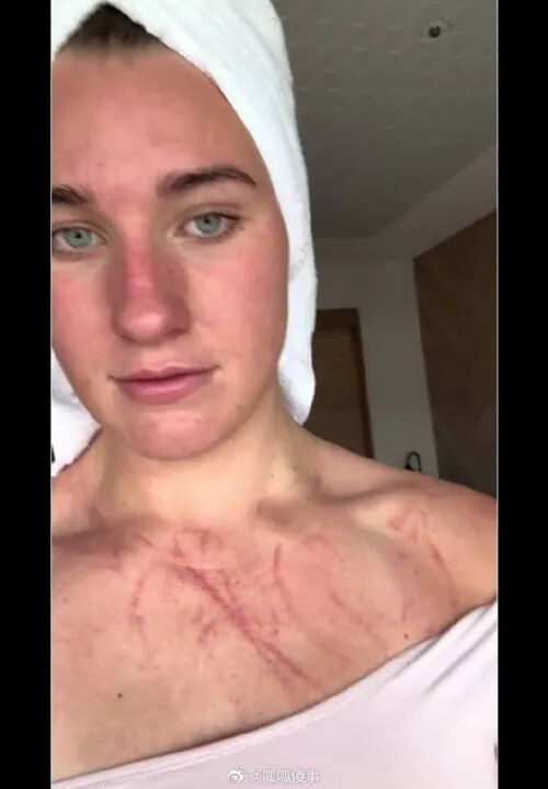 胸口全是血痕！中国女将晒照回应澳队员被抓伤：对抗项目，谁也别说谁