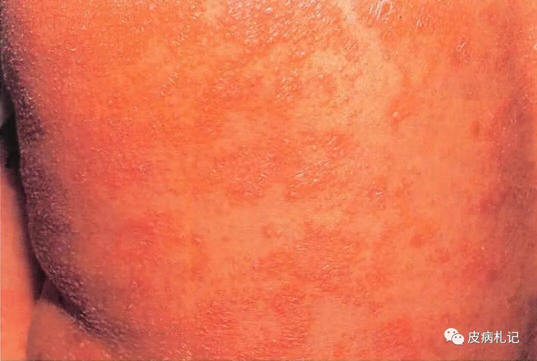 毛发红糠疹(PityriasisRubraPilaris，PAP)
