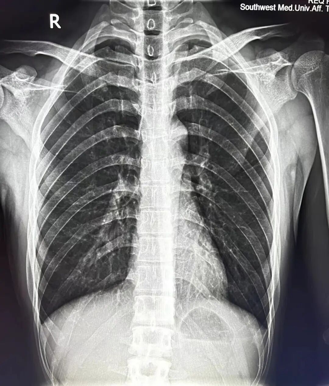 X光拍片为什么要等刚拍完X线，又让我拍CT，医生为什么要这样做_https://www.jmylbn.com_新闻资讯_第11张