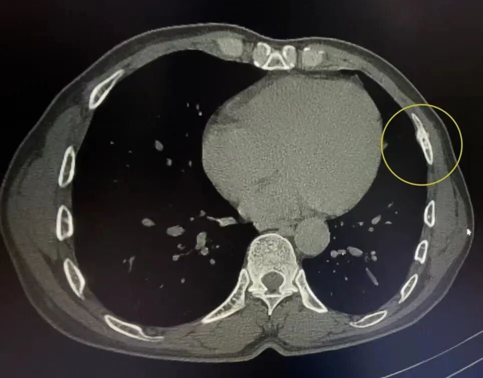 X光拍片为什么要等刚拍完X线，又让我拍CT，医生为什么要这样做_https://www.jmylbn.com_新闻资讯_第14张