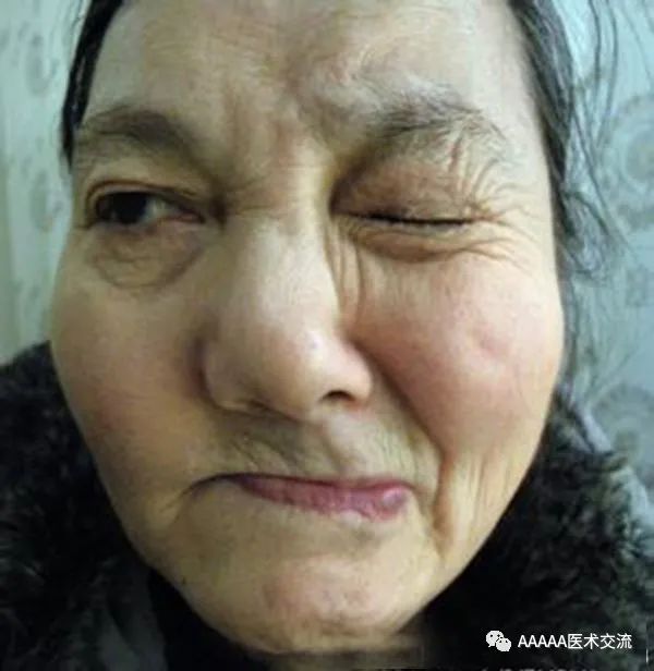 按摩第七十八课：面肌痉挛