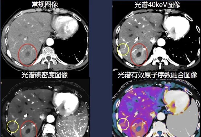 医讯怎么用医讯 ‖ 平昌县人民医院再添设备，飞利浦皓克256排光谱CT正式投入使用_https://www.jmylbn.com_新闻资讯_第13张