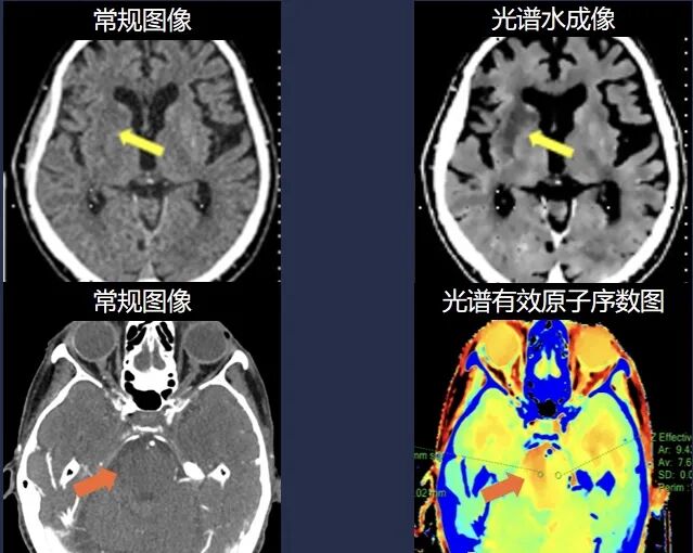 医讯怎么用医讯 ‖ 平昌县人民医院再添设备，飞利浦皓克256排光谱CT正式投入使用_https://www.jmylbn.com_新闻资讯_第12张