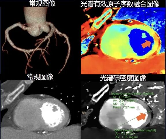 医讯怎么用医讯 ‖ 平昌县人民医院再添设备，飞利浦皓克256排光谱CT正式投入使用_https://www.jmylbn.com_新闻资讯_第11张