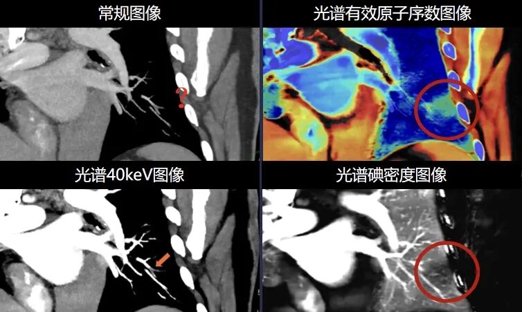 医讯怎么用医讯 ‖ 平昌县人民医院再添设备，飞利浦皓克256排光谱CT正式投入使用_https://www.jmylbn.com_新闻资讯_第14张