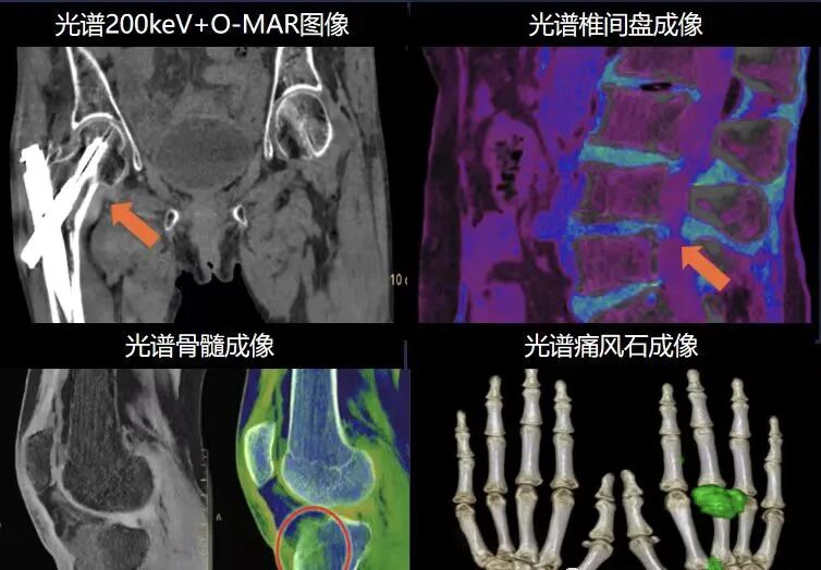 医讯怎么用医讯 ‖ 平昌县人民医院再添设备，飞利浦皓克256排光谱CT正式投入使用_https://www.jmylbn.com_新闻资讯_第15张