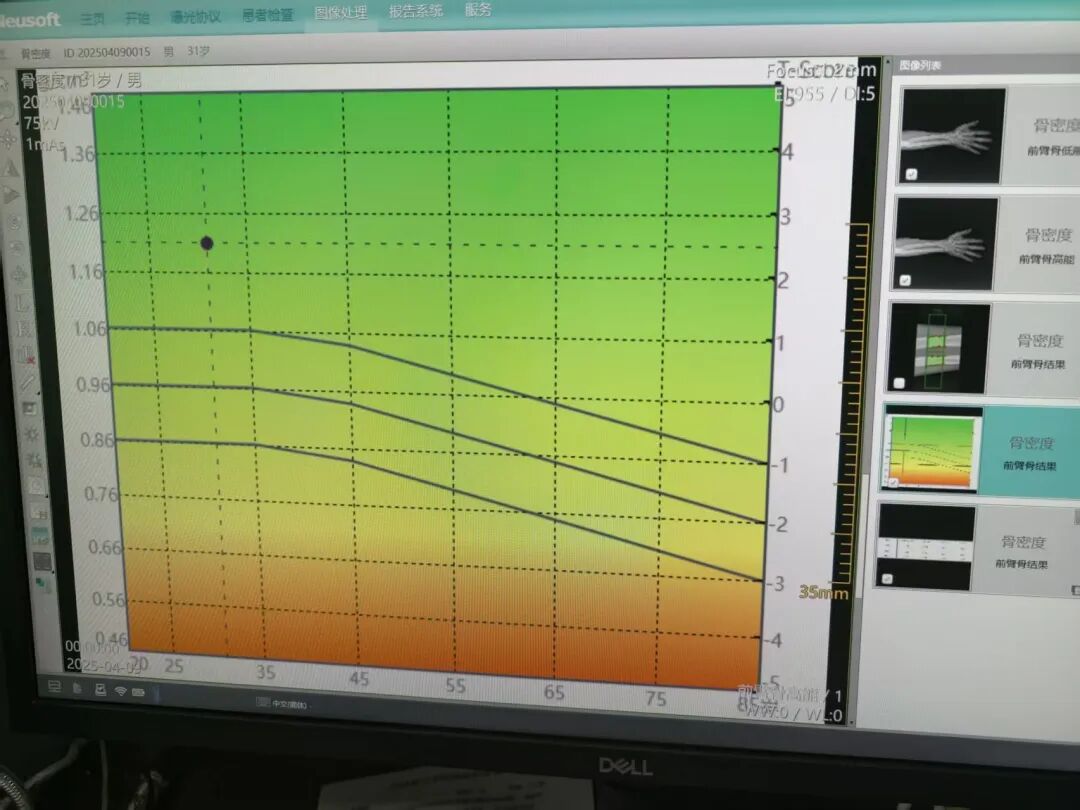 DR机怎么曝光【好消息】精准又安心！我院新 DR 机解锁骨密度与尘肺筛查双功能_https://www.jmylbn.com_新闻资讯_第3张